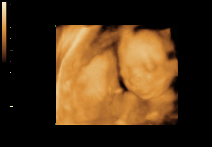 3D ultrasound image at 21 weeks